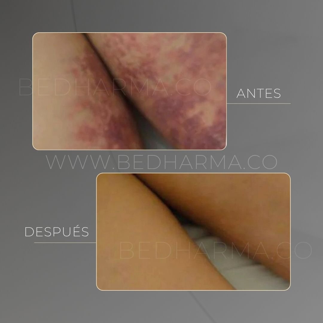 Indiba before and after at Be Dharma in Medellín — case 3
