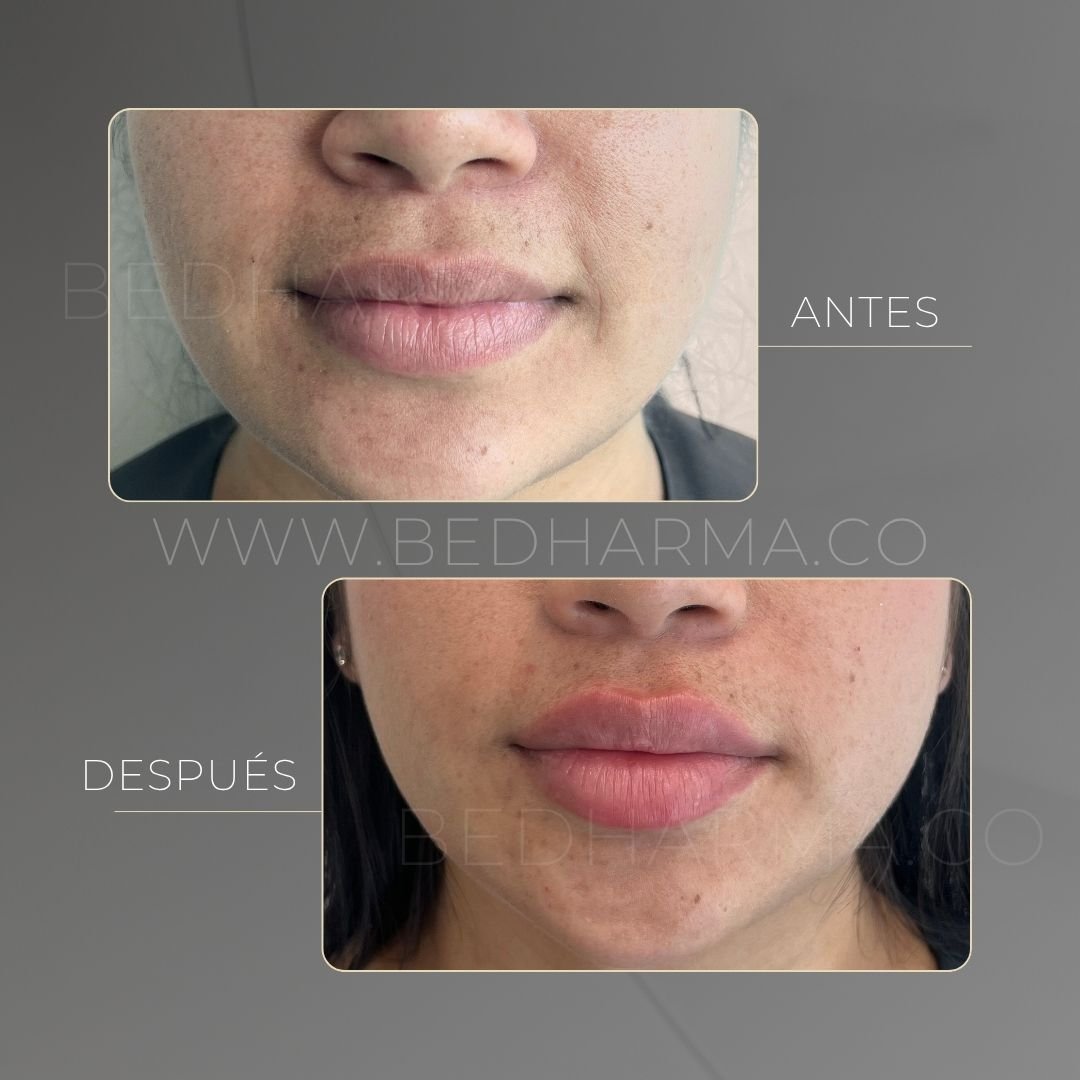 Lip augmentation before and after at Be Dharma in Medellín — case 1