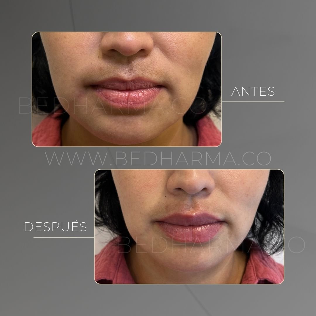 Lip augmentation before and after at Be Dharma in Medellín — case 11