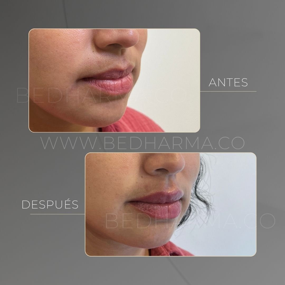 Lip augmentation before and after at Be Dharma in Medellín — case 12