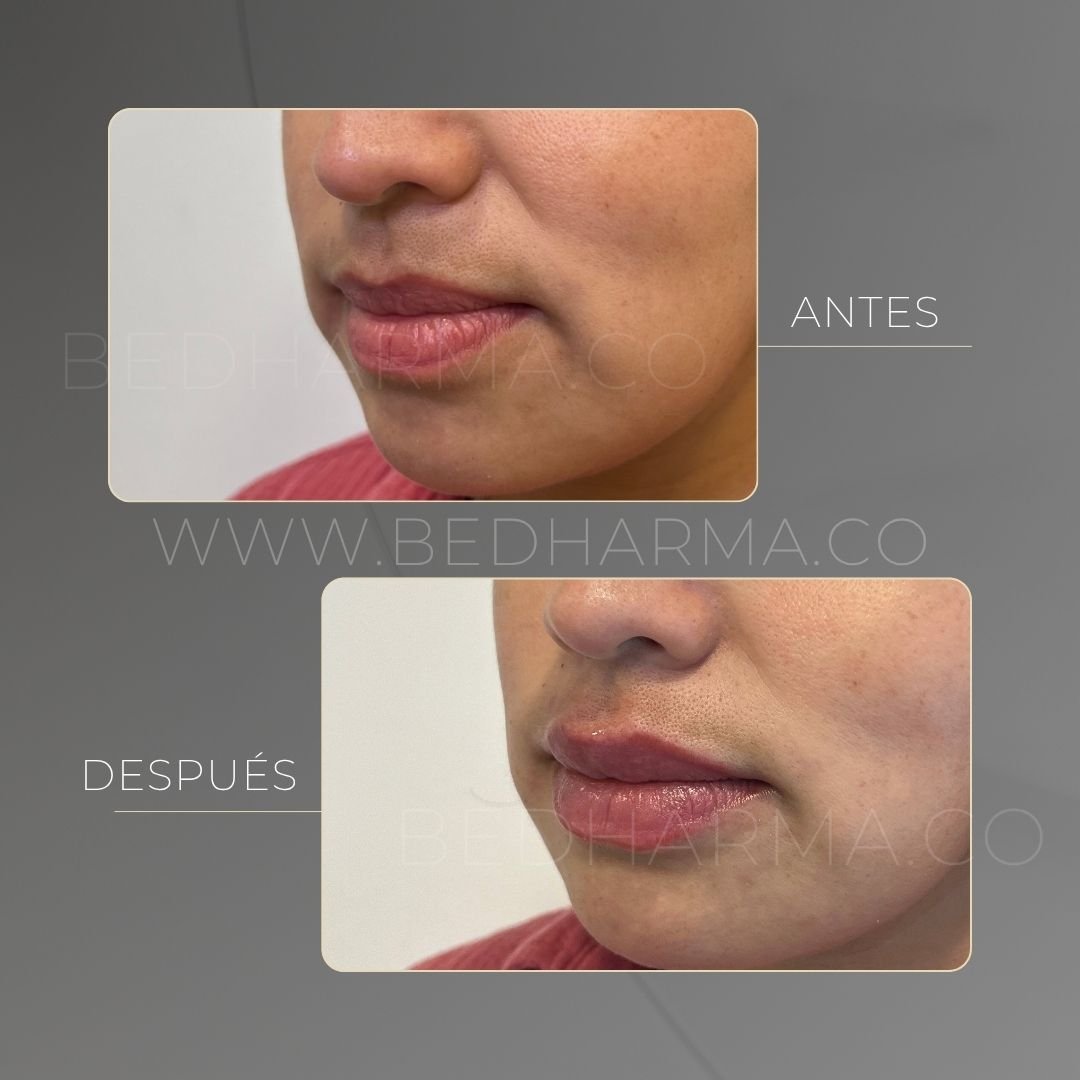 Lip augmentation before and after at Be Dharma in Medellín — case 13