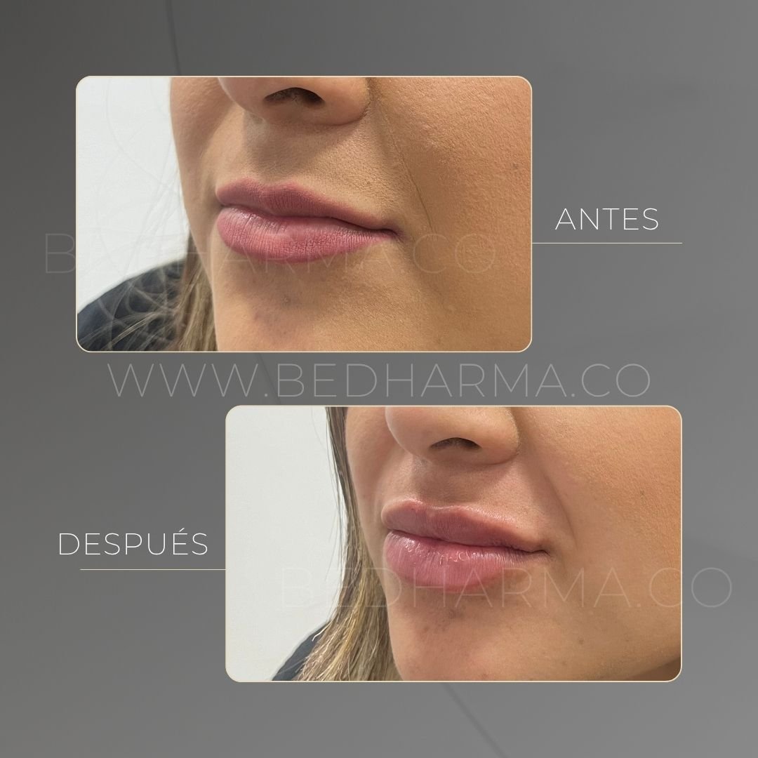 Lip augmentation before and after at Be Dharma in Medellín — case 14