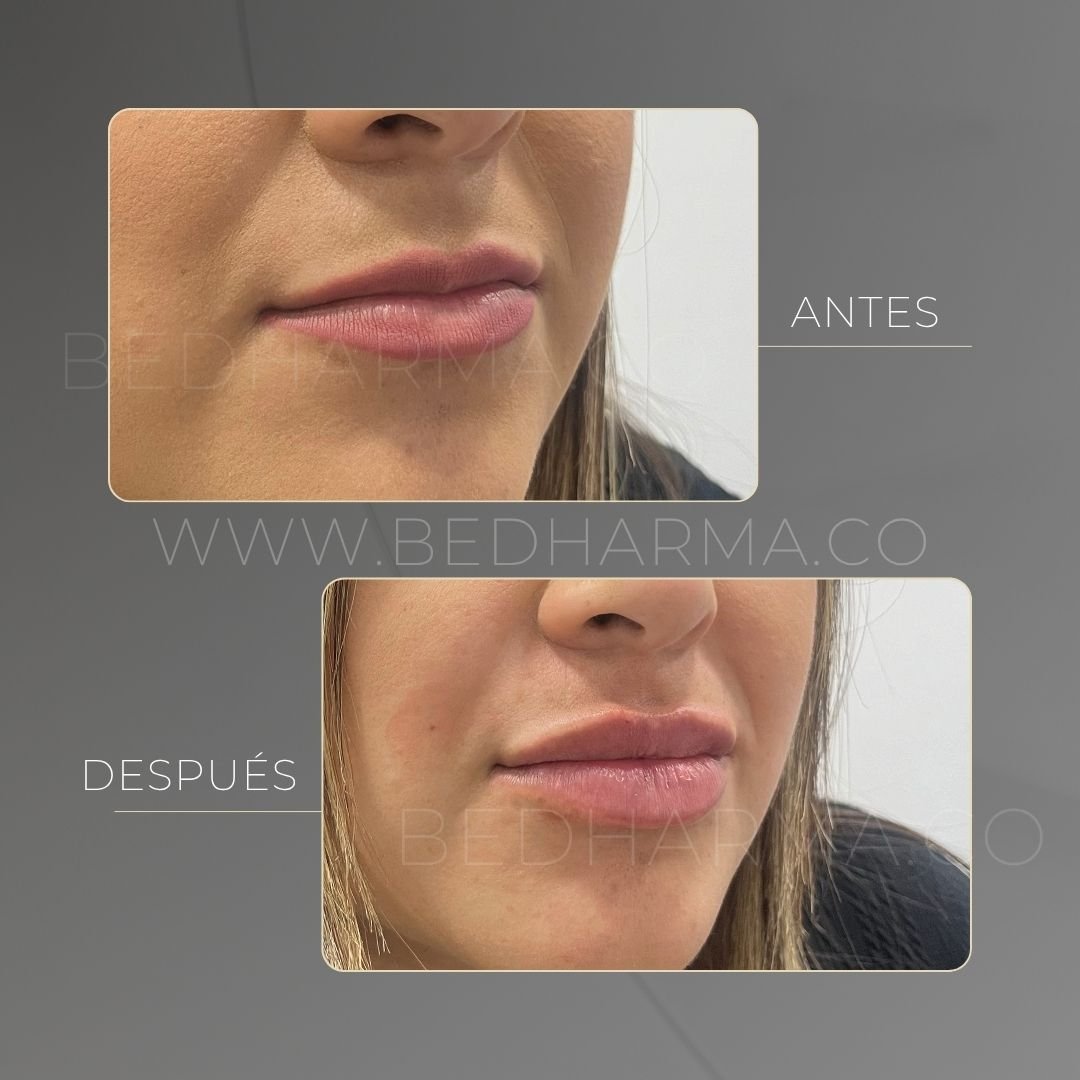 Lip augmentation before and after at Be Dharma in Medellín — case 15