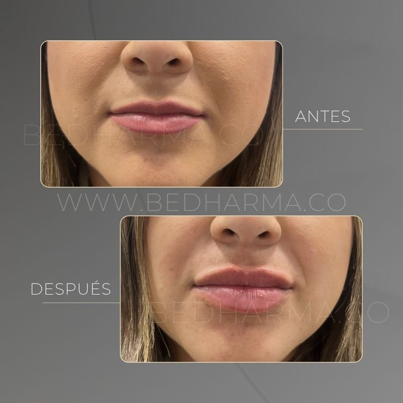 Lip augmentation before and after at Be Dharma in Medellín — case 16