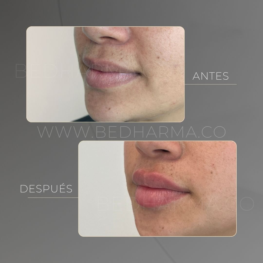 Lip augmentation before and after at Be Dharma in Medellín — case 2