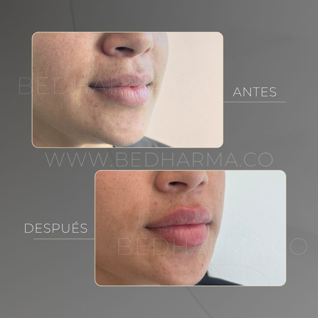 Lip augmentation before and after at Be Dharma in Medellín — case 3