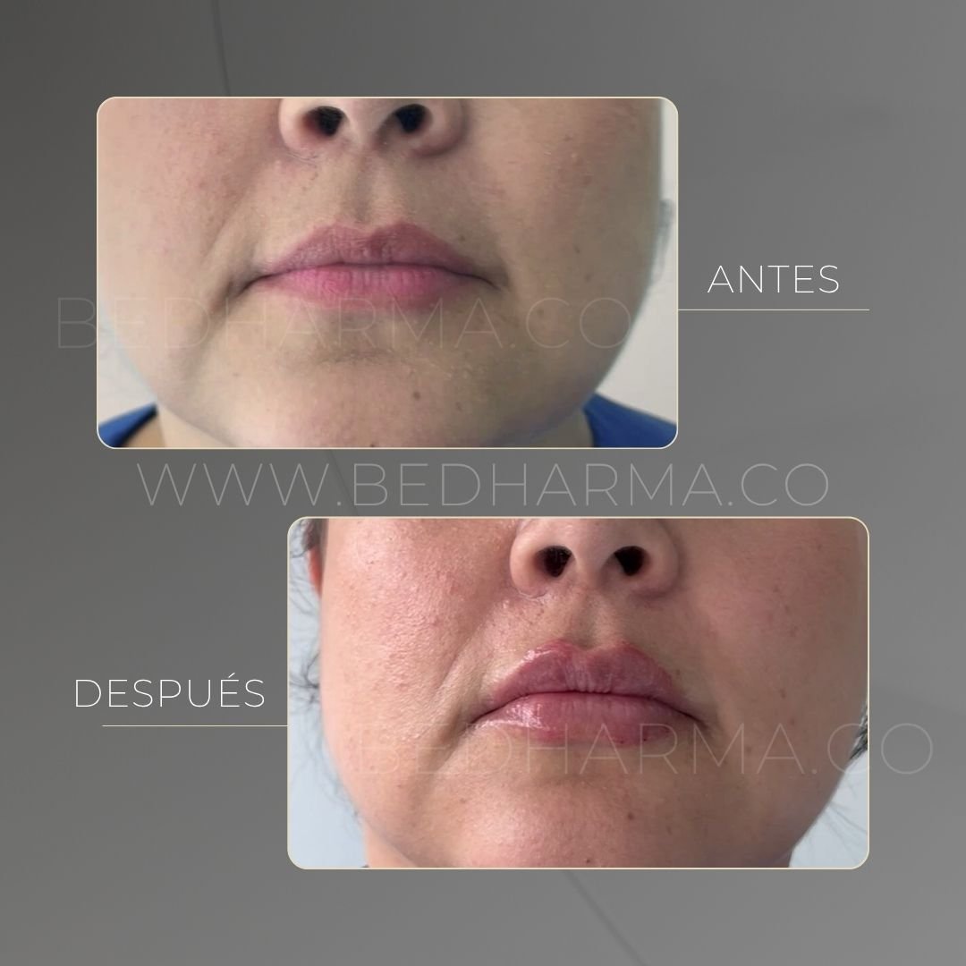 Lip augmentation before and after at Be Dharma in Medellín — case 4