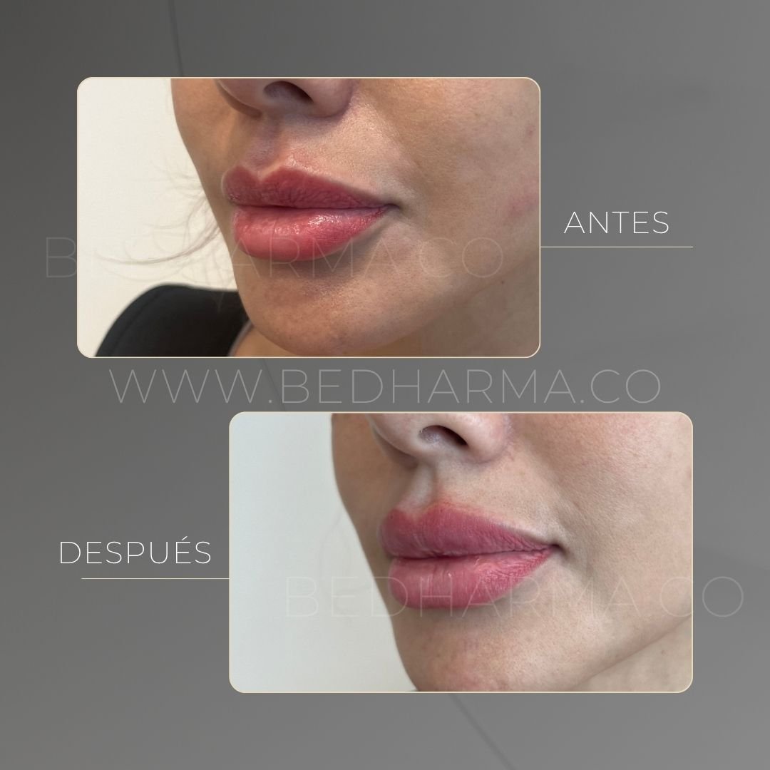 Lip augmentation before and after at Be Dharma in Medellín — case 5