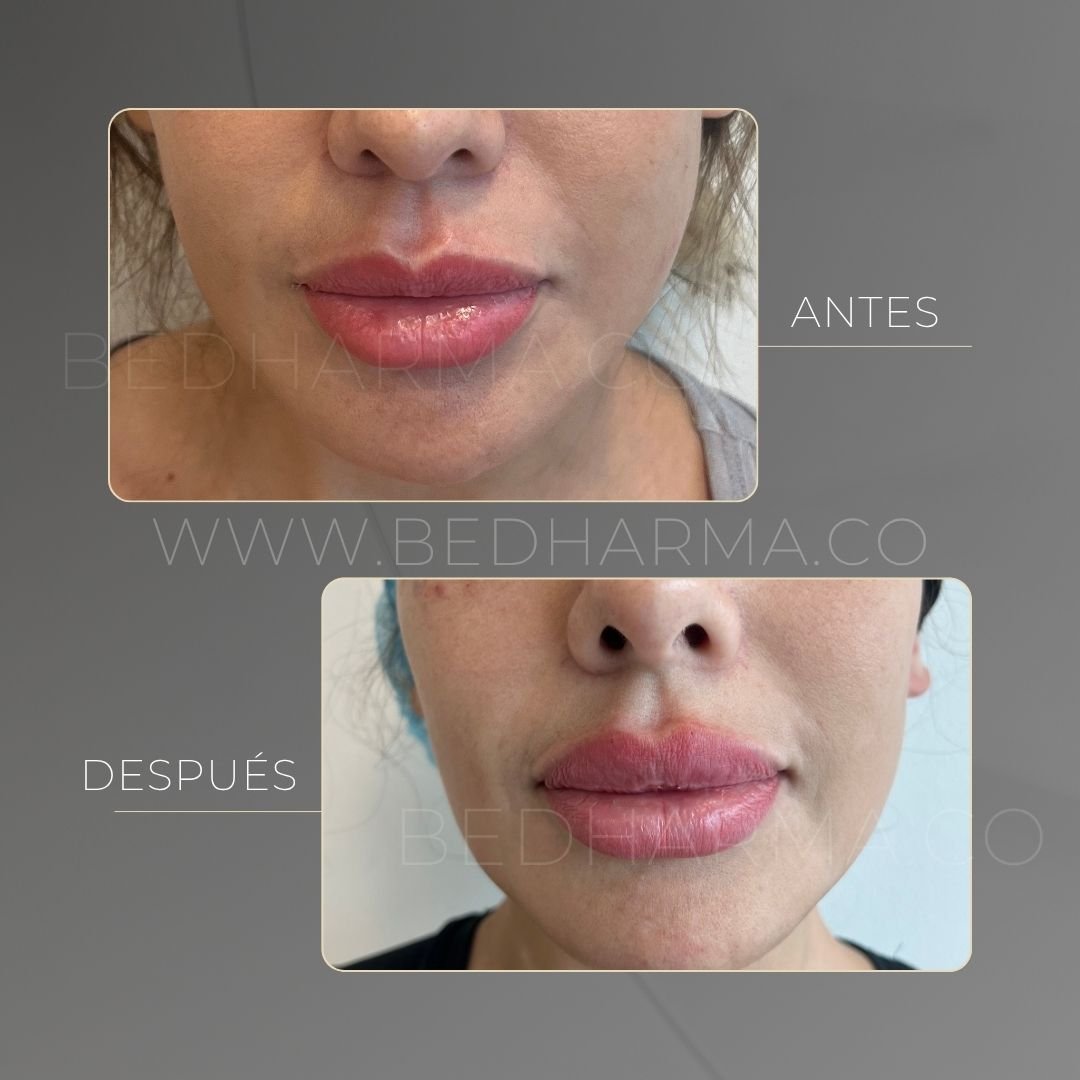 Lip augmentation before and after at Be Dharma in Medellín — case 6