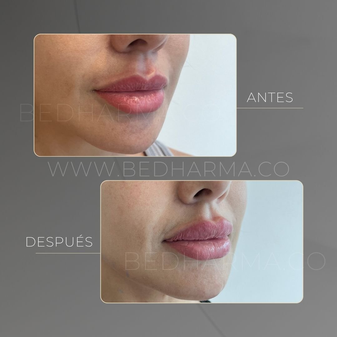Lip augmentation before and after at Be Dharma in Medellín — case 7