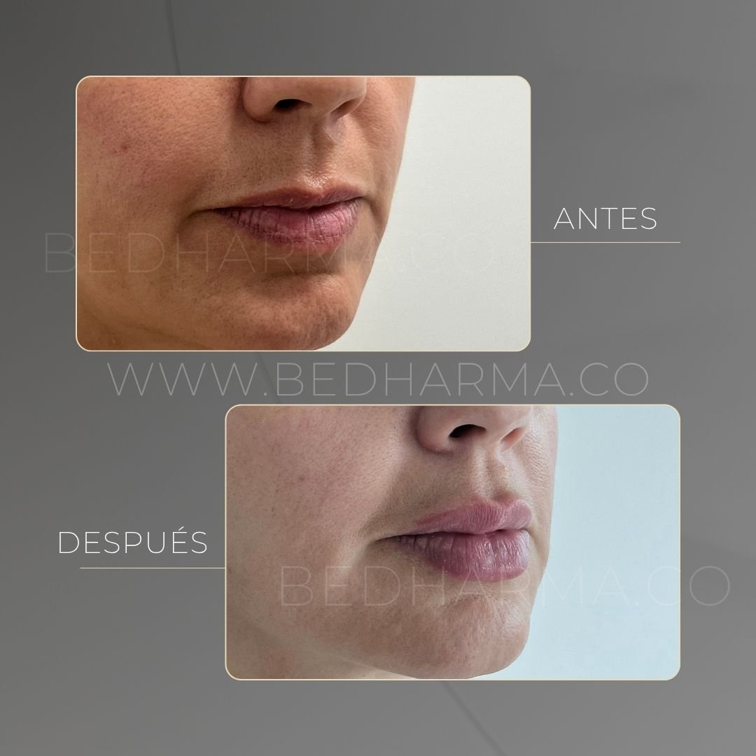 Lip augmentation before and after at Be Dharma in Medellín — case 8