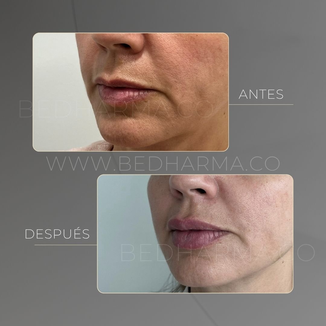 Lip augmentation before and after at Be Dharma in Medellín — case 9