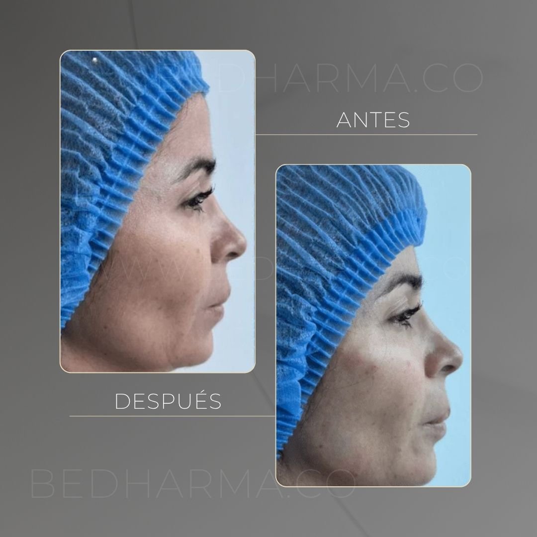 Radiesse before and after case at Be Dharma Medellín