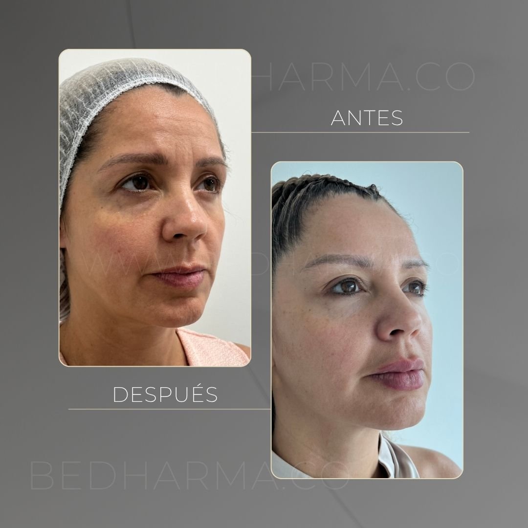 Radiesse before and after in Medellín at Be Dharma