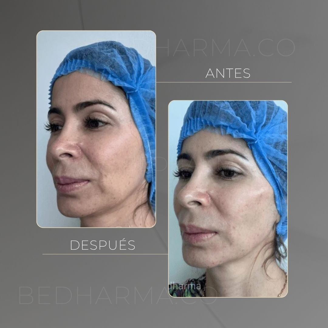 Radiesse facial contour before and after at Be Dharma