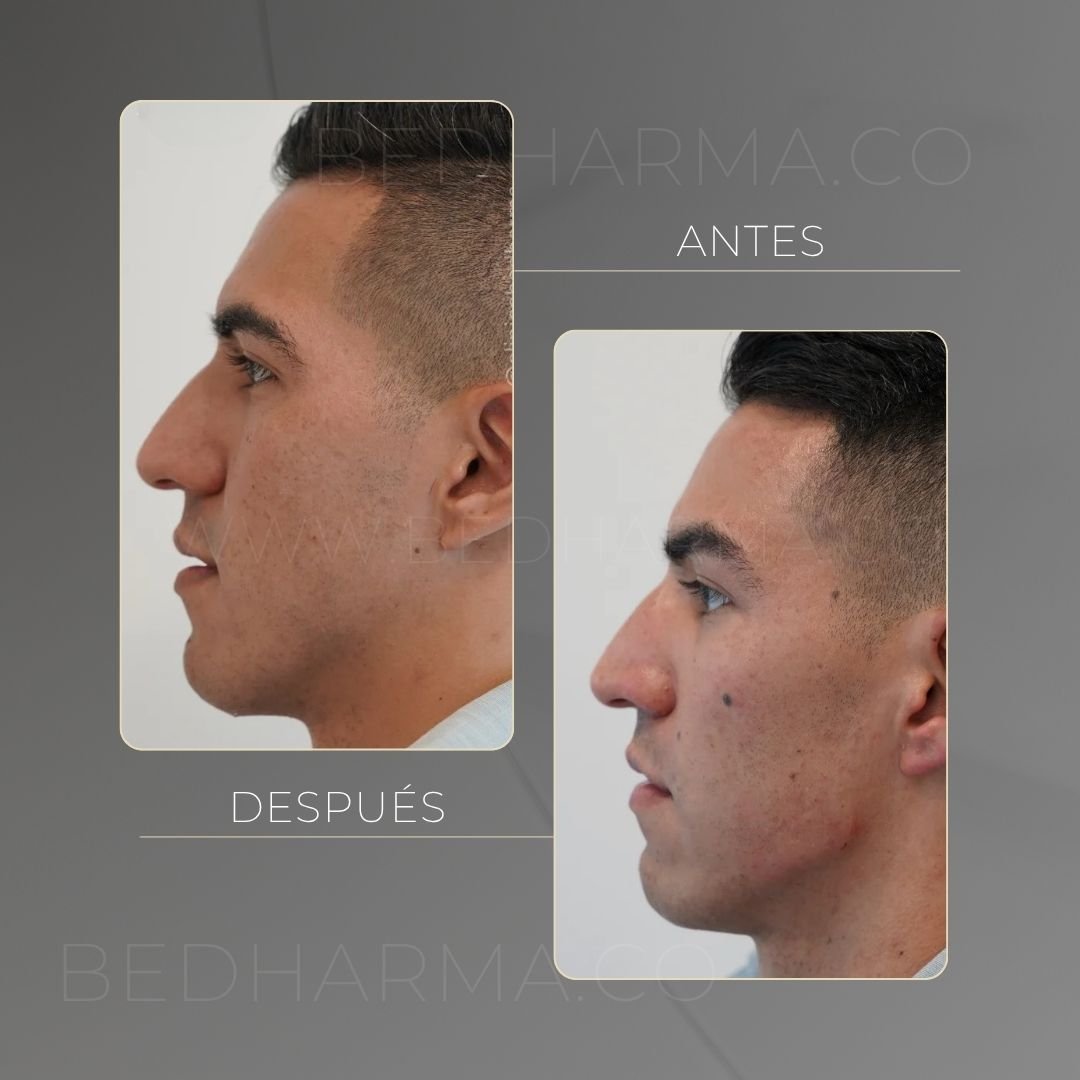 Radiesse jawline before and after in Medellín