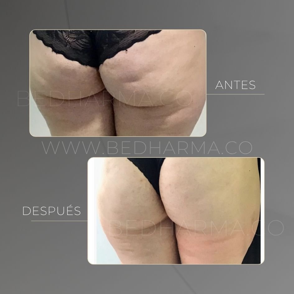 Tensamax before and after for skin firming in Medellín at Be Dharma