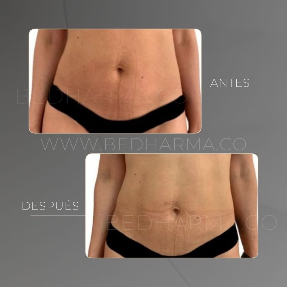 Tensamax radiofrequency before and after at Be Dharma Medellín