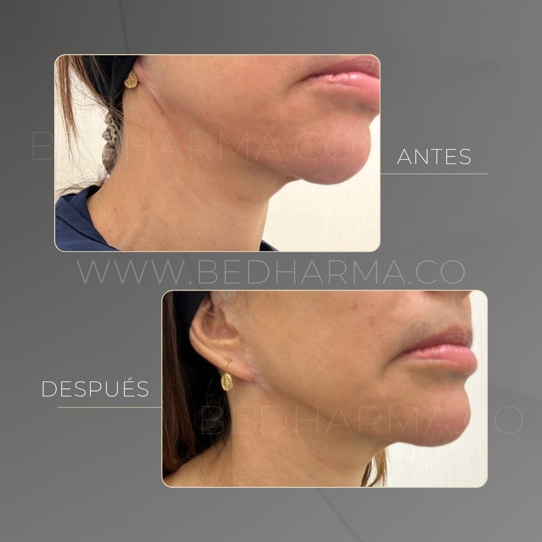Ultraformer MPT before and after at Be Dharma in Medellín — case 1