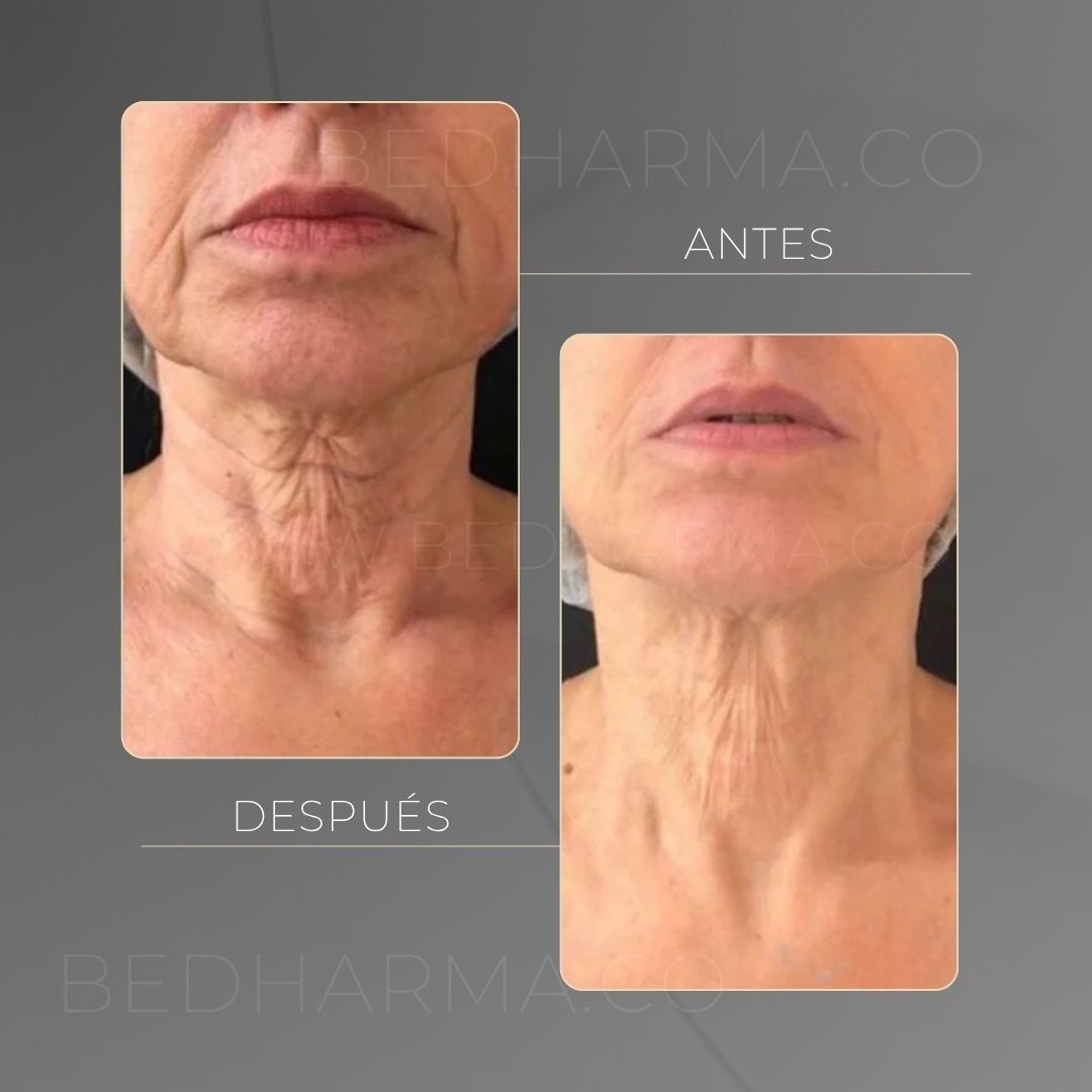 Ultraformer MPT before and after at Be Dharma in Medellín — case 11