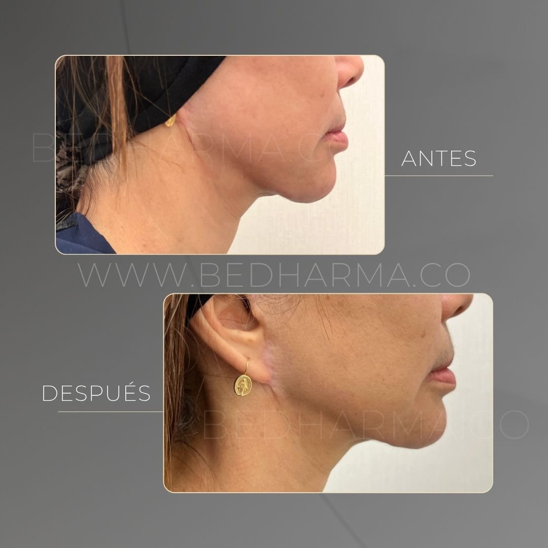 Ultraformer MPT before and after at Be Dharma in Medellín — case 2