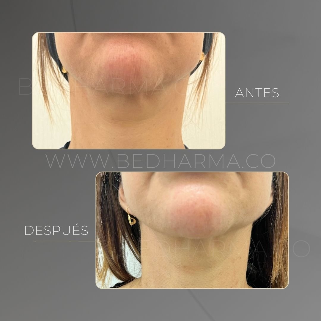 Ultraformer MPT before and after at Be Dharma in Medellín — case 4