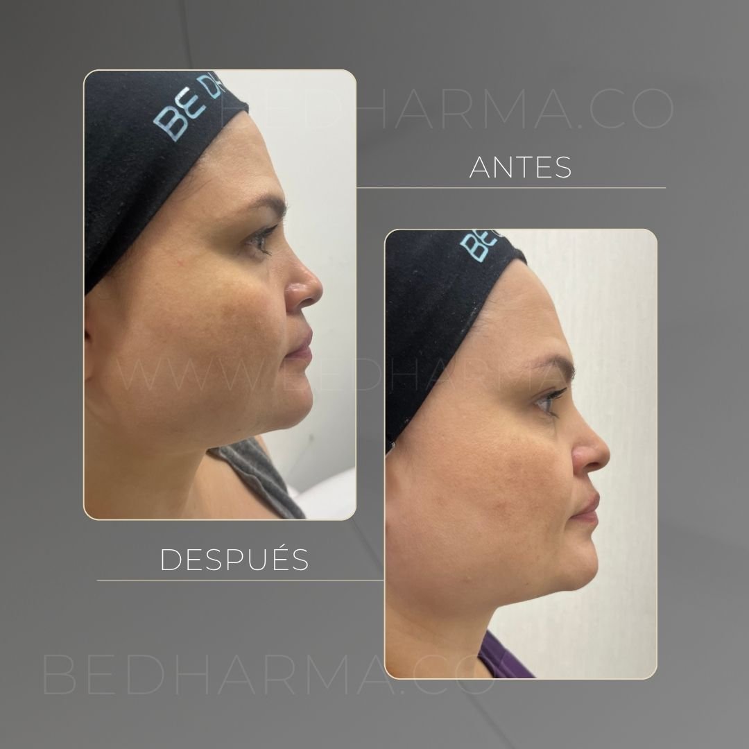 Ultraformer MPT before and after at Be Dharma in Medellín — case 7