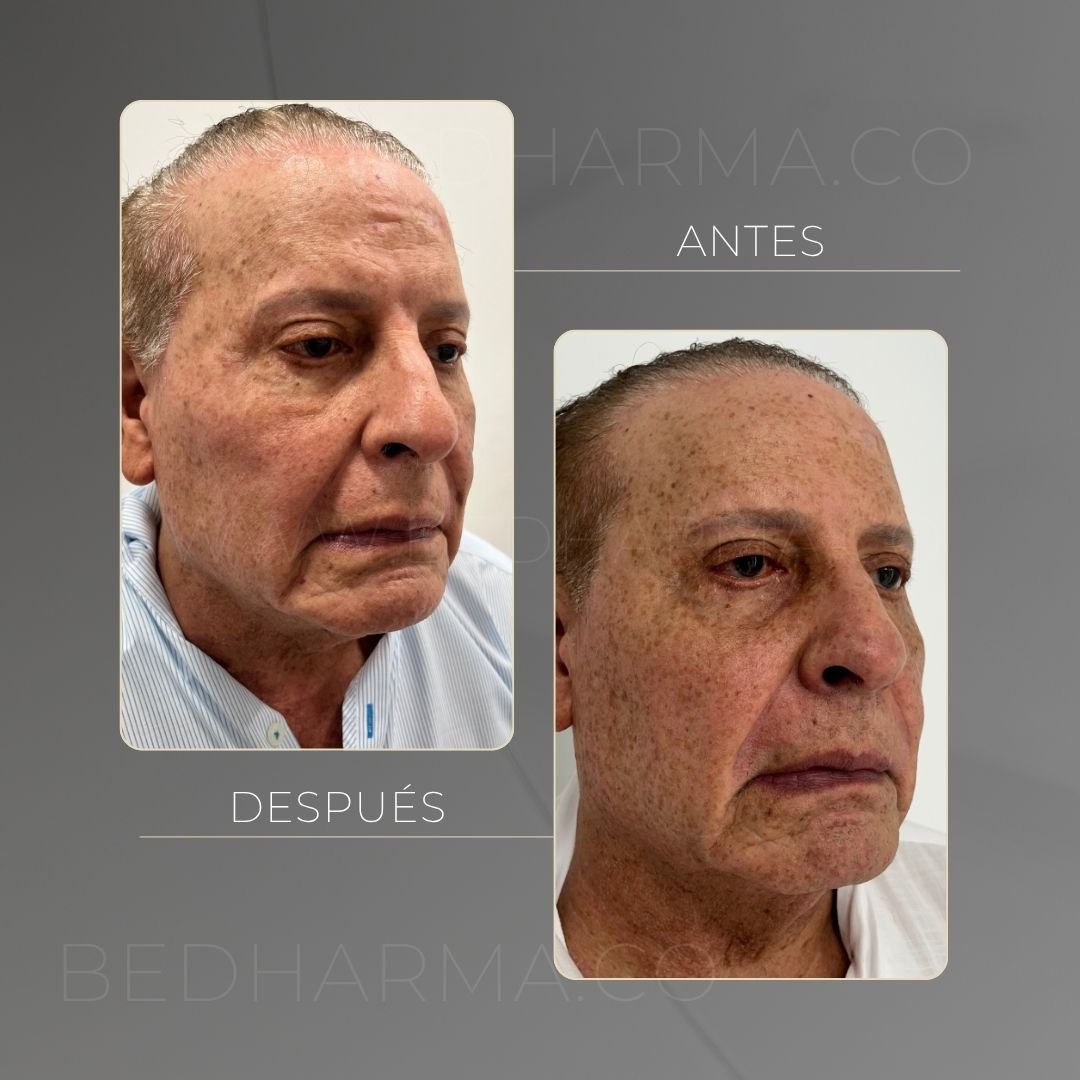 Ultraformer MPT before and after at Be Dharma in Medellín — case 8