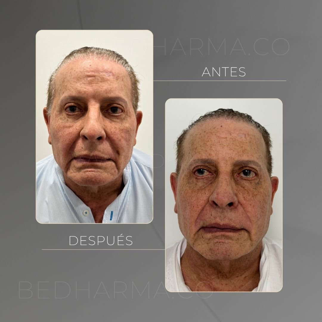 Ultraformer MPT before and after at Be Dharma in Medellín — case 9