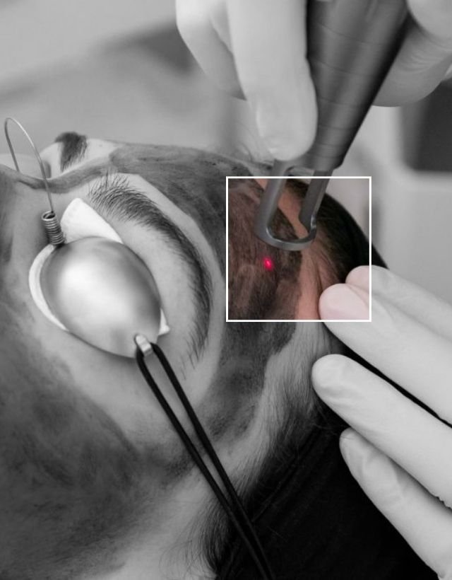 Hollywood Peel en Medellín - Centro Estético Be Dharma