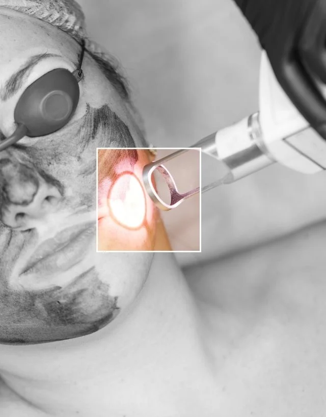 ColorMAX laser for dark spots in Medellín at Be Dharma