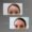 Botox en la frente antes y después - Clínica Estética Be Dharma Medellín