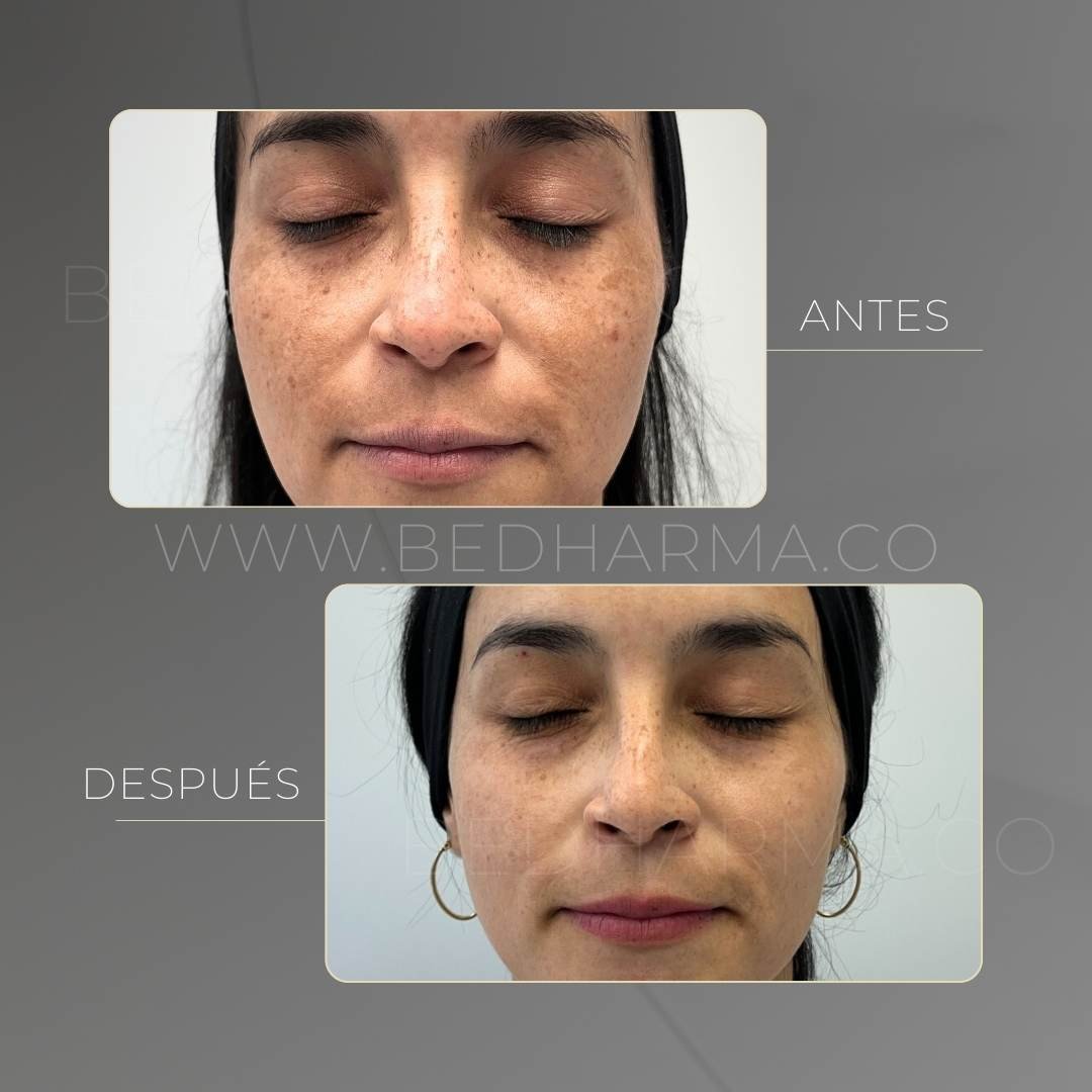 Eliminación de manchas con láser colormax antes y después - Clínica estética Be Dharma Medellín 2