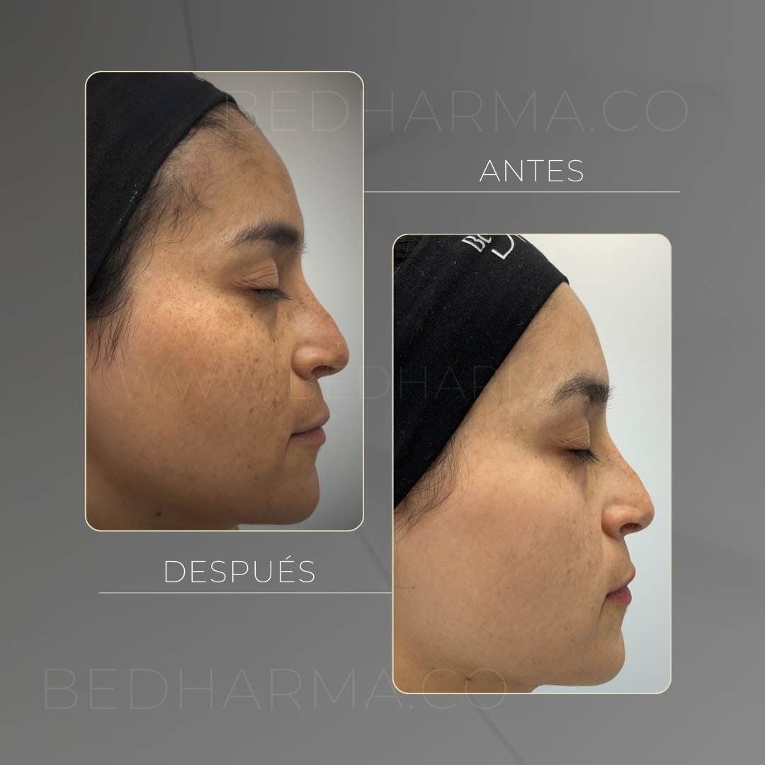 Eliminación de manchas con láser colormax antes y después - Clínica estética Be Dharma Medellín