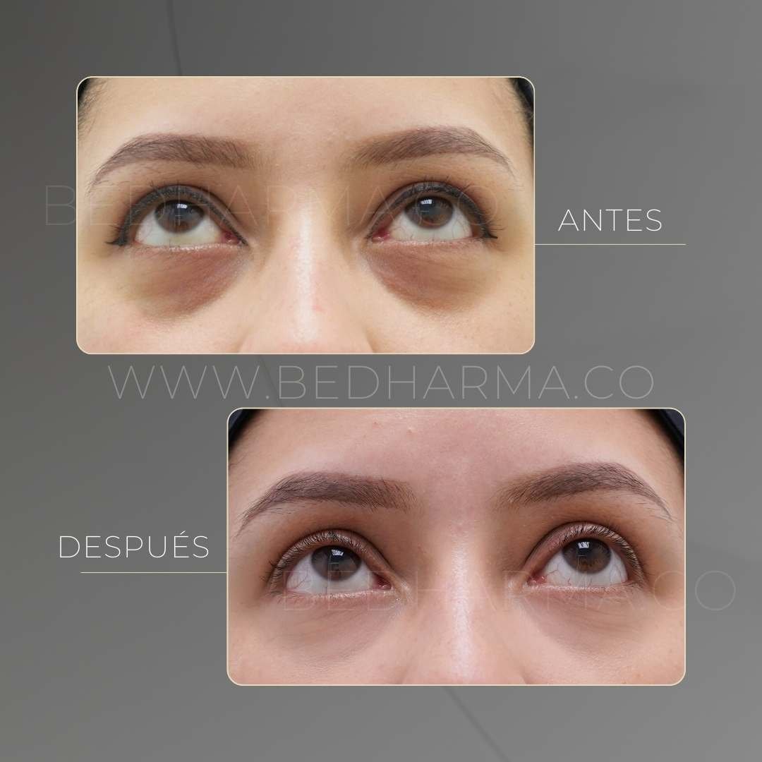 Eliminación de ojeras antes y después - Clínica estética Be Dharma Medellín