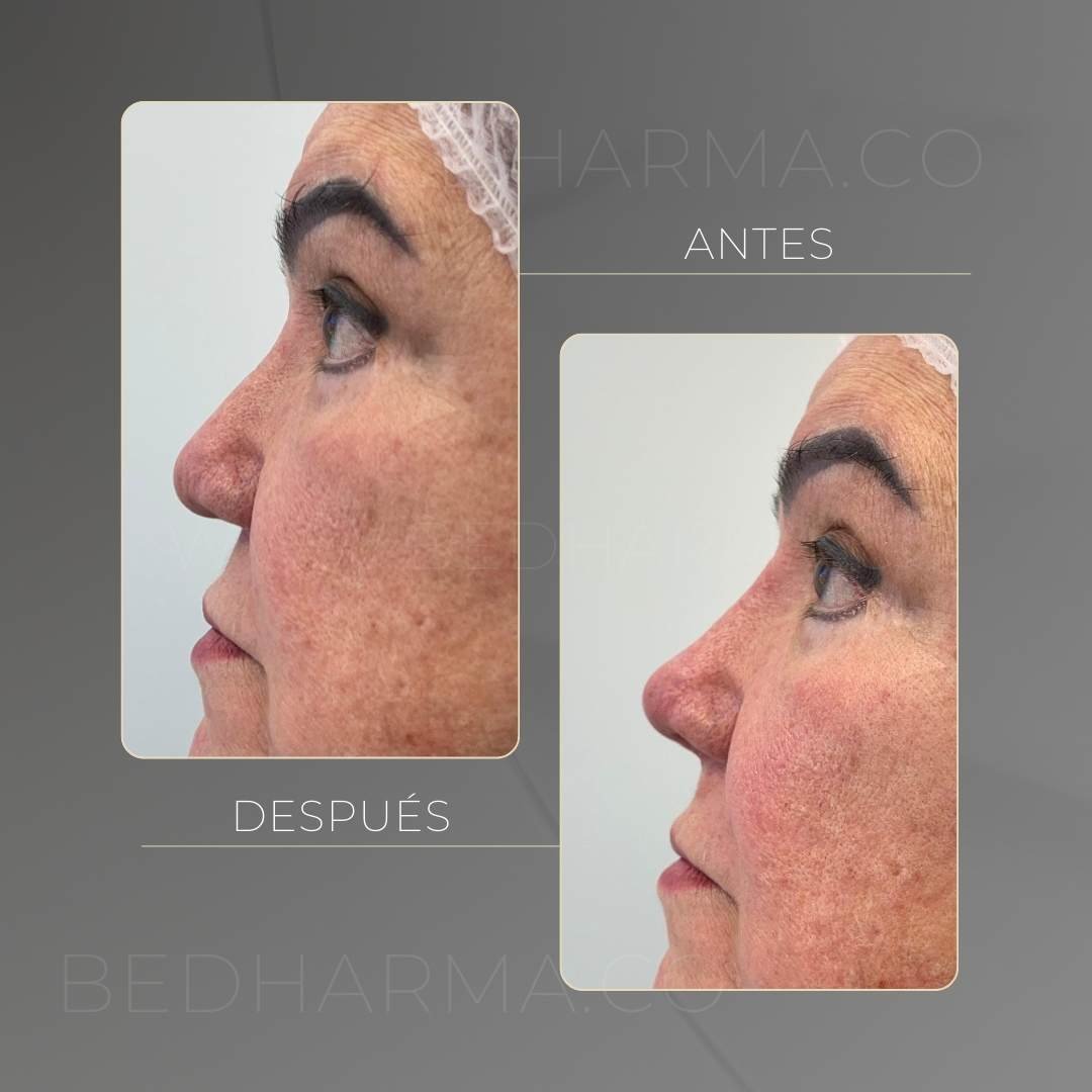 Rinomodelación antes y después con ácido hialurónico en la clínica estética Be Dharma de Medellín