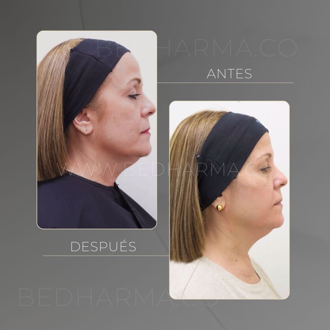 Sculptra antes y después en Medellín - Clínica estética Be Dharma 2