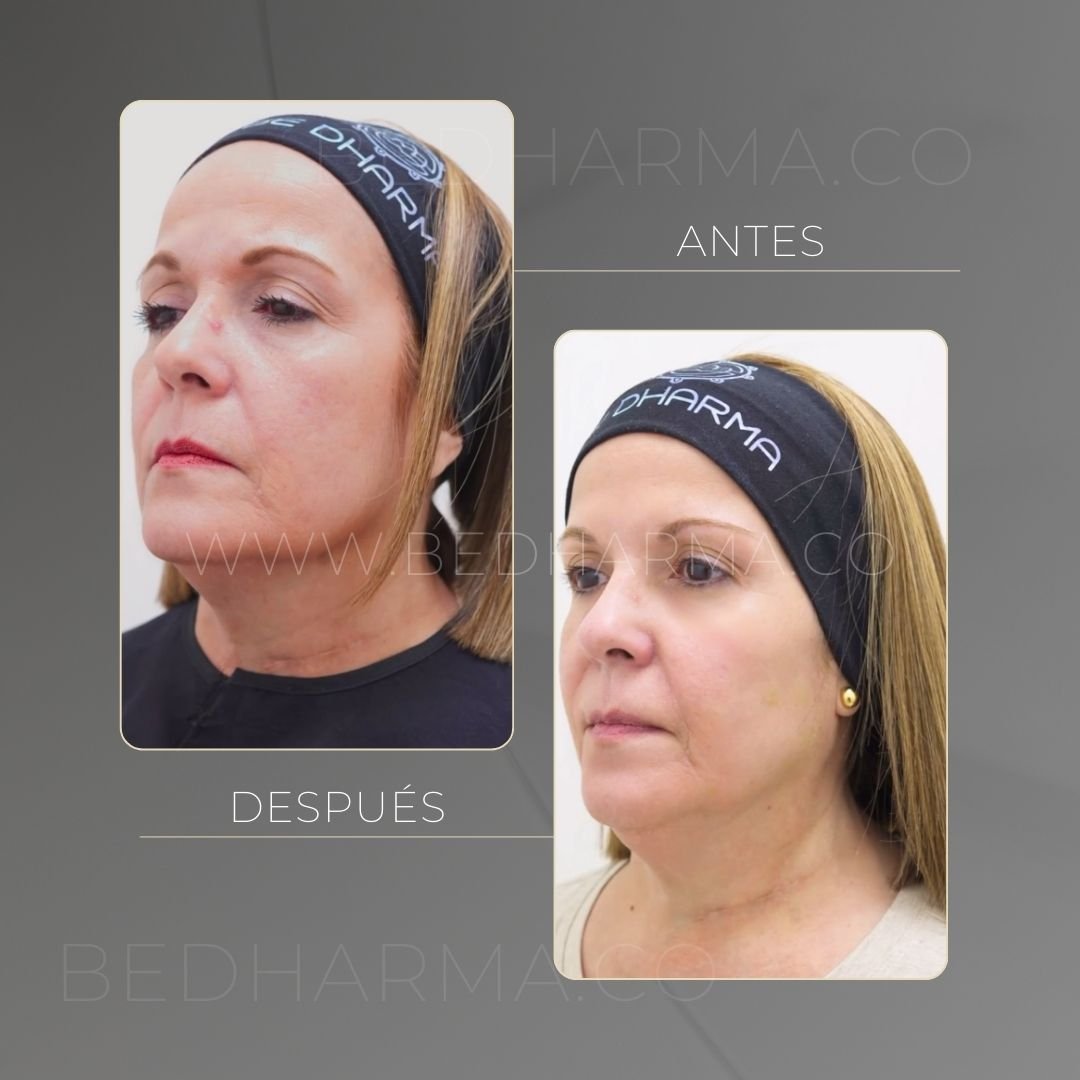 Sculptra antes y después en Medellín - Clínica estética Be Dharma 3
