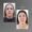 Sculptra antes y después en Medellín - Clínica estética Be Dharma