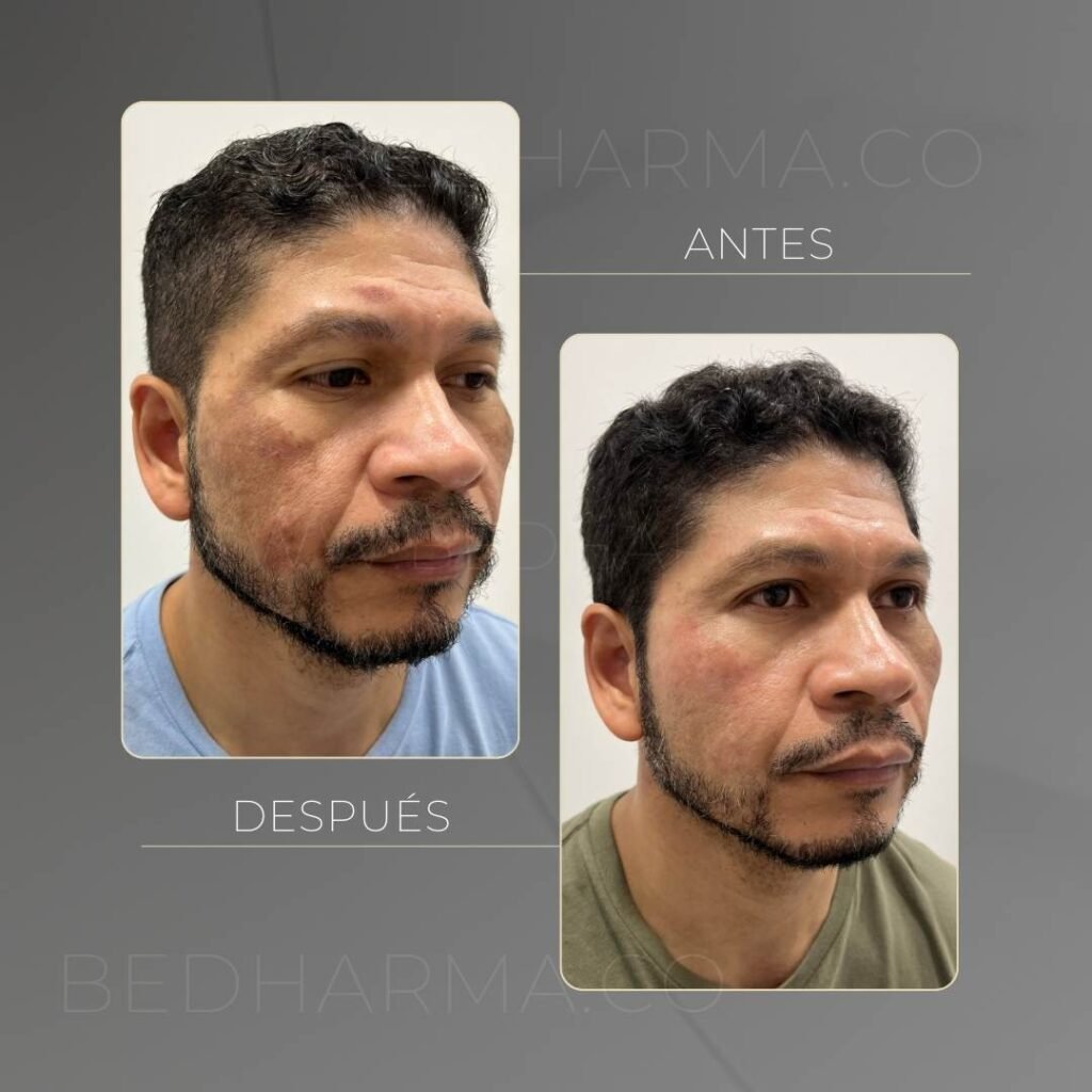 Tratamiento con láser colormax antes y después - Clínica estética Be Dharma Medellín