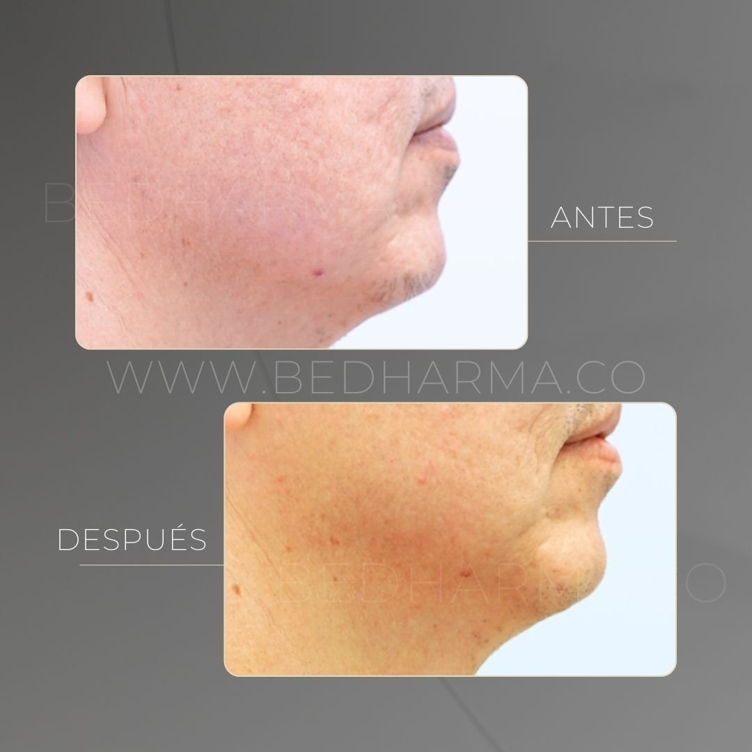 Chin projection with hyaluronic acid before and after in Medellín at Be Dharma