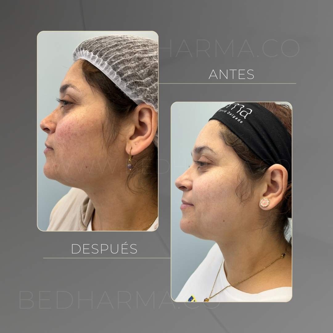 ColorMAX laser before and after in Medellín at Clínica Be Dharma — case 1