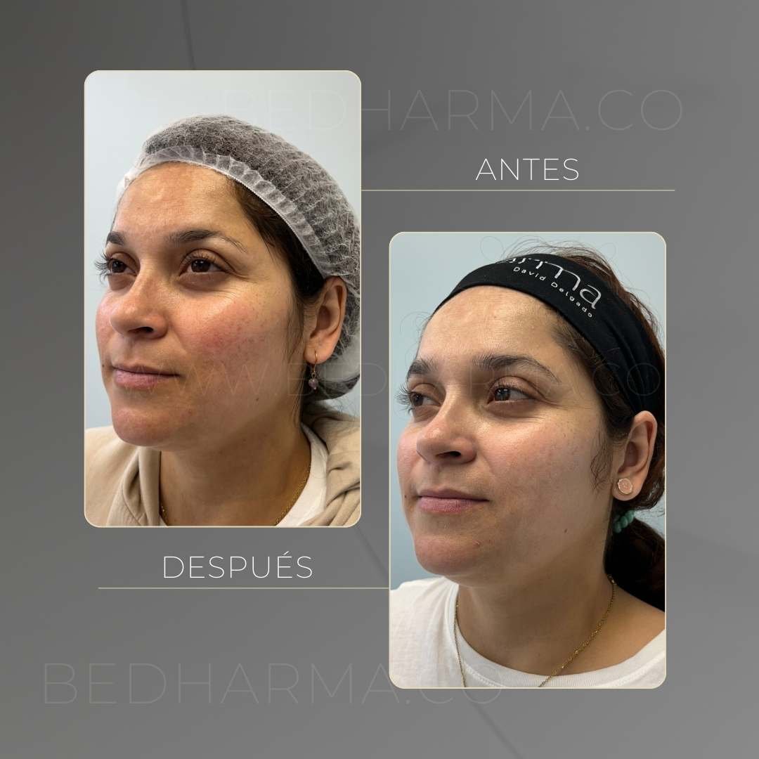 ColorMAX laser before and after in Medellín at Clínica Be Dharma — case 2