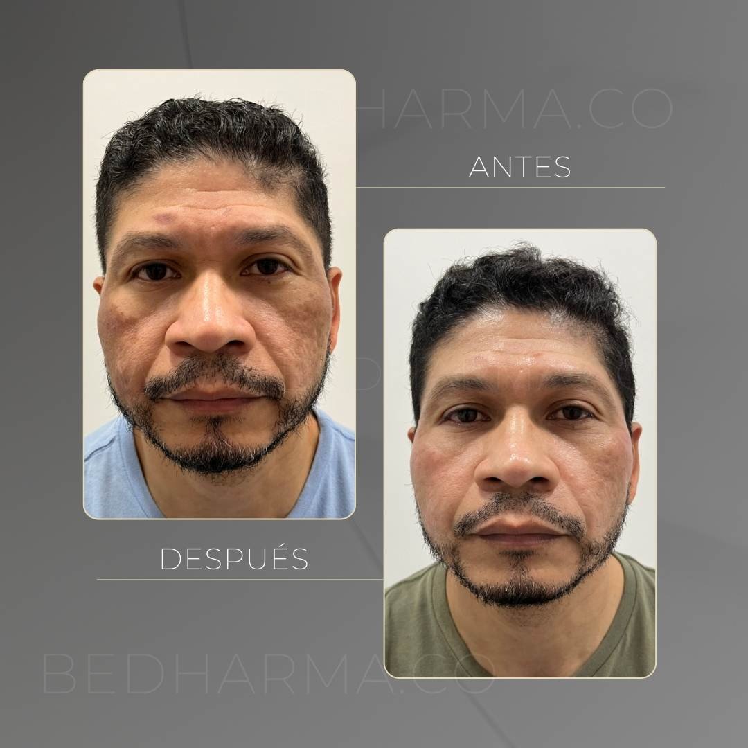 ColorMAX laser before and after in Medellín at Clínica Be Dharma — case 5