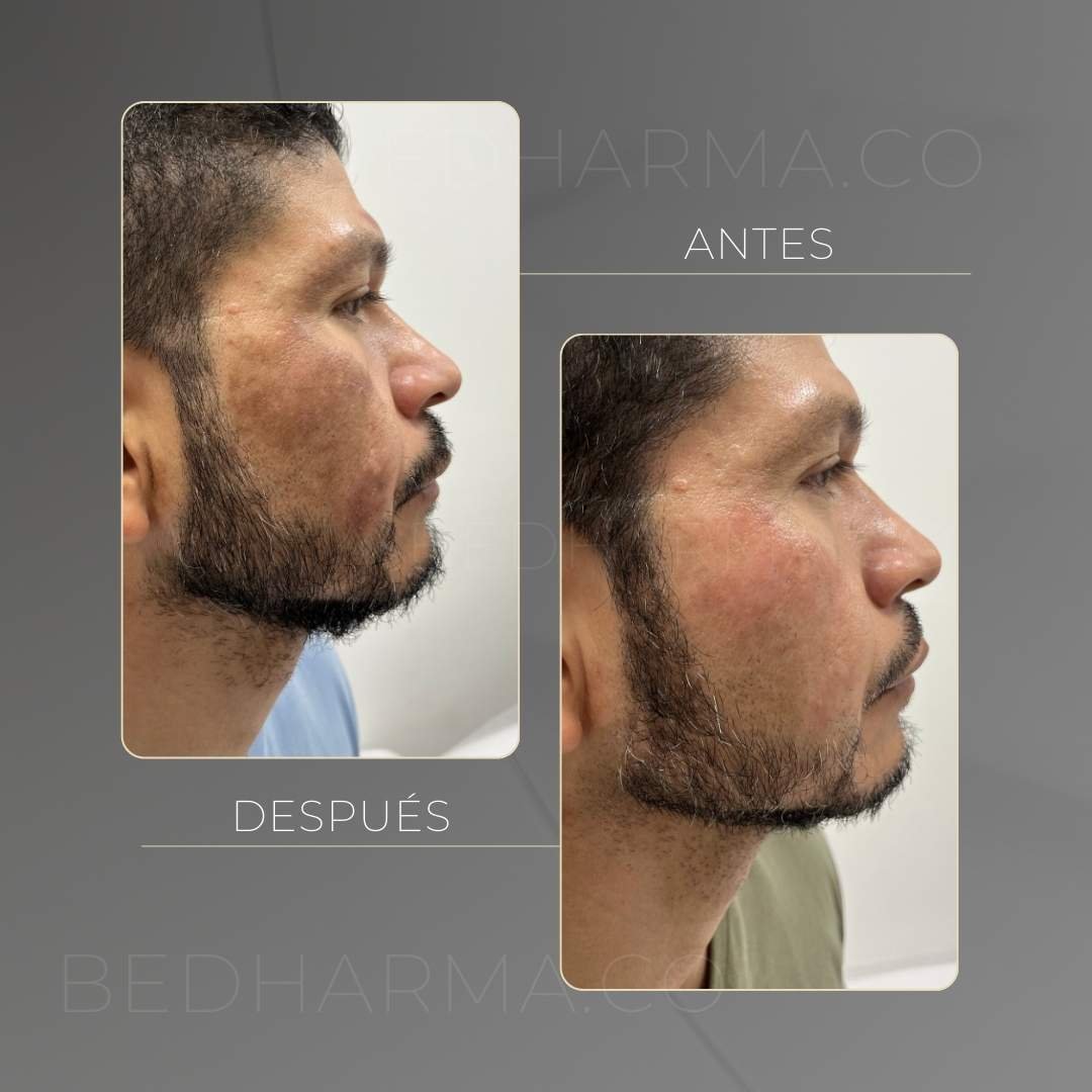 ColorMAX laser before and after in Medellín at Clínica Be Dharma — case 7