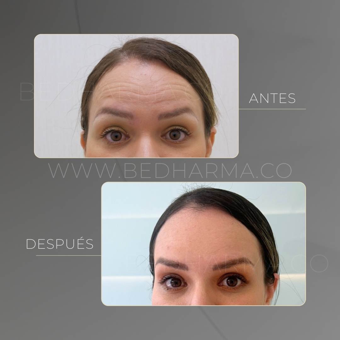 Forehead Botox before and after at Clínica Be Dharma in Medellín