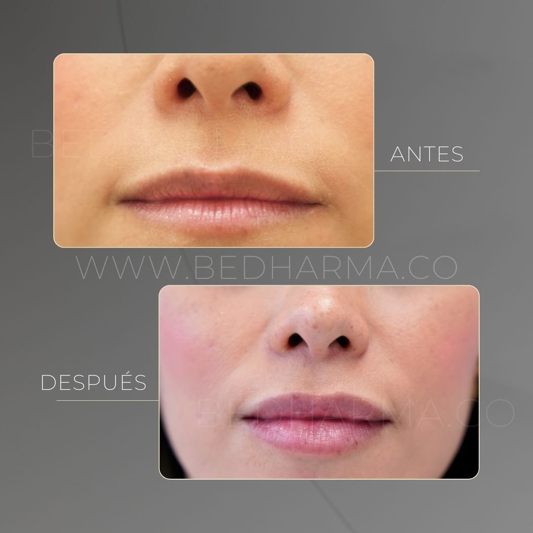 Lip filler with hyaluronic acid before and after at Clínica Be Dharma, Medellín