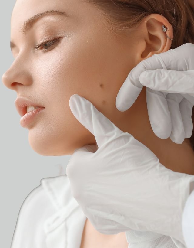 Mole cauterization in Medellín at Clínica Be Dharma
