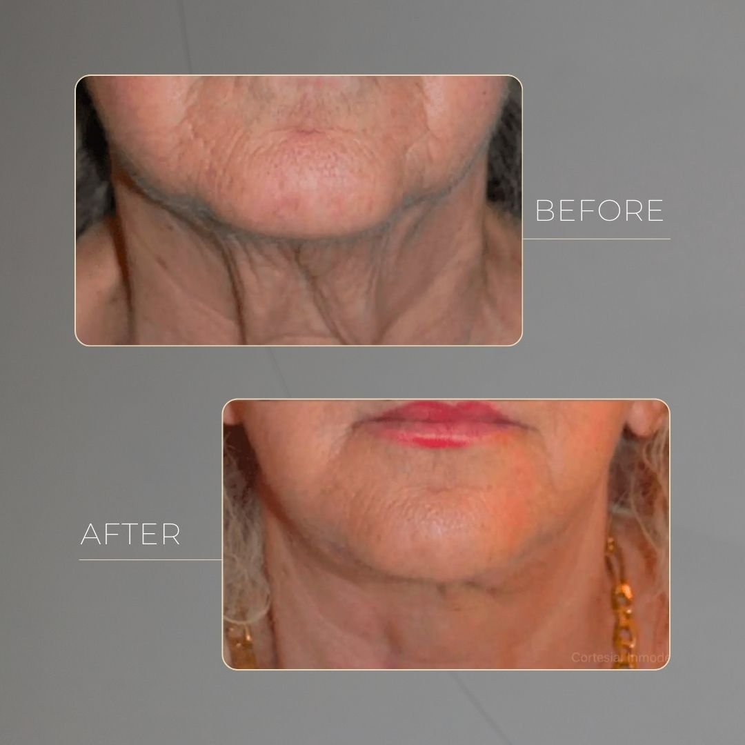 Morpheus8 before and after in Medellín at Clínica Be Dharma — case 1