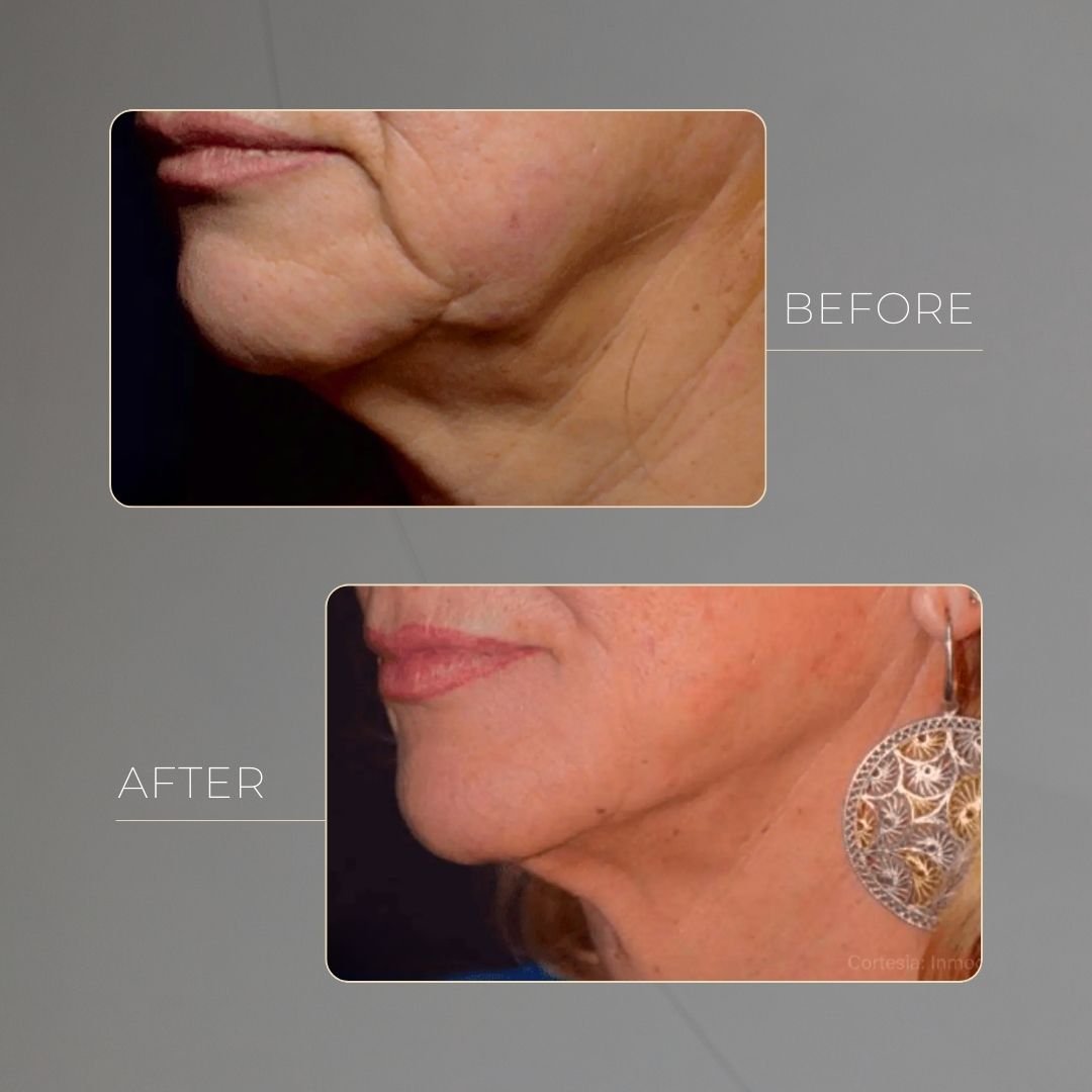 Morpheus8 before and after in Medellín at Clínica Be Dharma — case 2